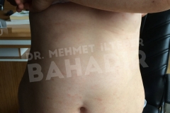 Nach der Behandlung