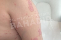 Before treatment
