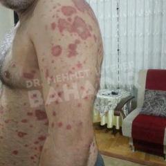 Пациент Mehmet Altun