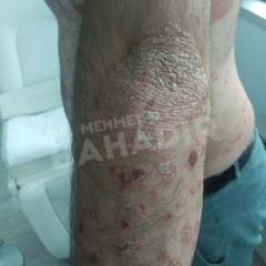 Пациент Veysi B.