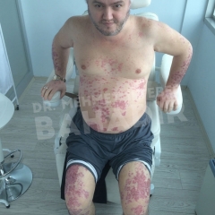 Пациент Yakup Genc